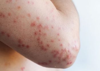 SARAMPIÓN NUEVO LEÓN CASOS   Informe Regio